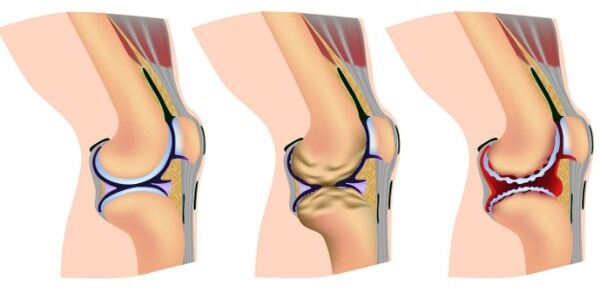 Knee joint deformation stages