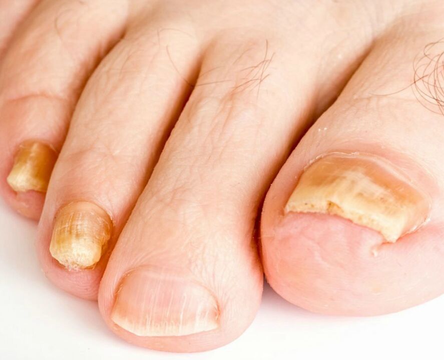 nail fungus