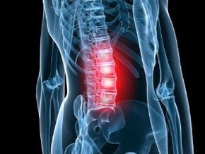 Lumbar spine osteochondrosis