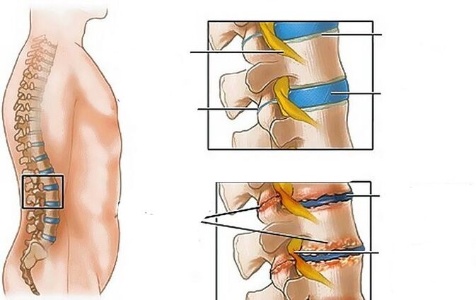 Lumbar osteochondrosis
