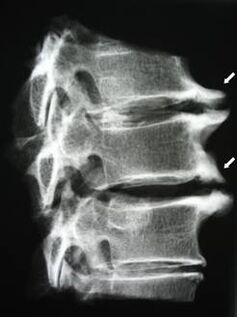 Cervical spine osteophytes cause neck pain