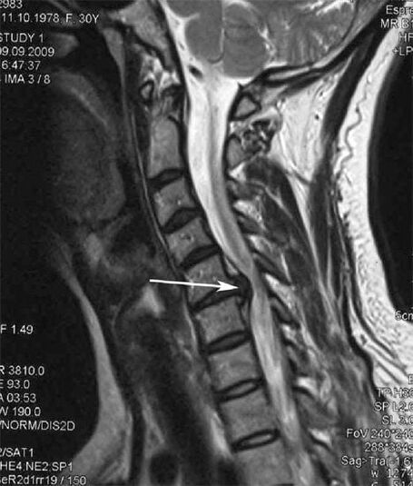 Spinal cord injury causes neck pain