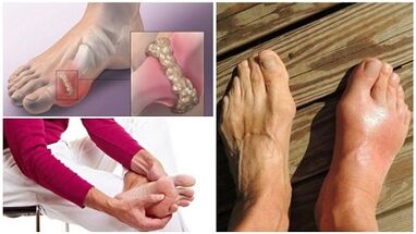 What is Arthritis of the joints